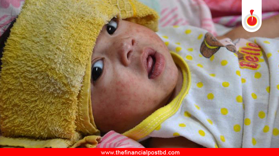 6 more die with measles symptoms in 24 hours